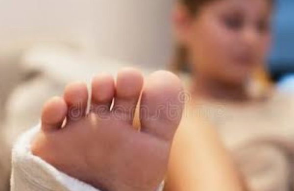 girl broken leg